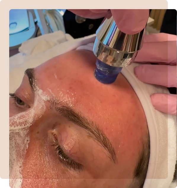 Hydrafacial purity: Revolutionerende hudpleje i en travl verden